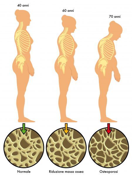 osteoporosi 3