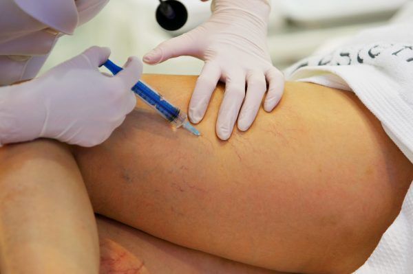 Treatment of varicose veins