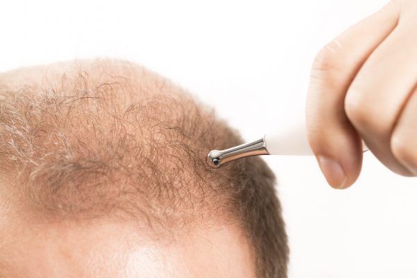 Baldness Alopecia man hair loss medicine bald treatment transplantation France