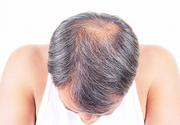 hair loss and grey hair, Male head with hair loss symptoms front side