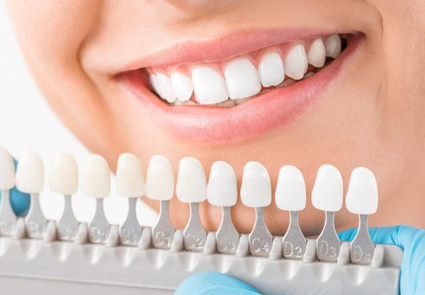 Beautiful smile and white teeth of a young woman. Matching the shades of the implants or the process of teeth whitening.